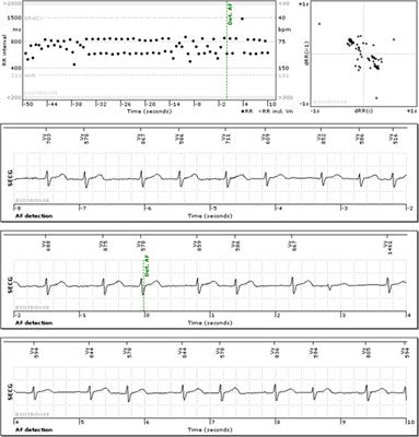 Implantable cardiac monitors: artificial intelligence and signal processing reduce remote ECG review workload and preserve arrhythmia detection sensitivity